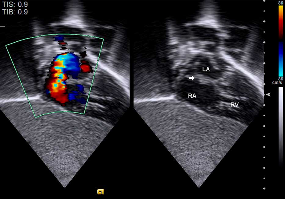 Echocardiography Of Hypoplastic Left Heart Syndrome Cardiology In The