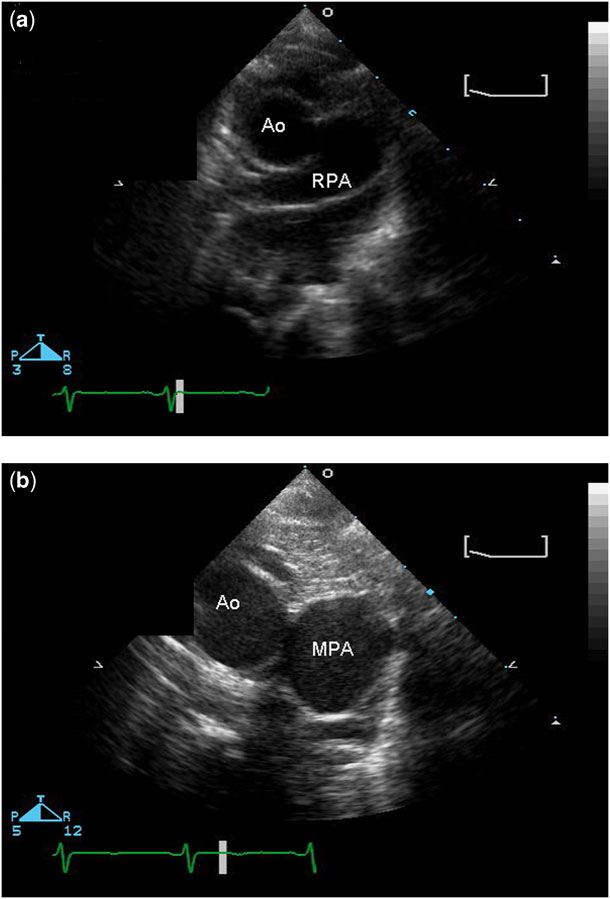 Echocardiography Of The Aortopulmonary Window Aorto Ventricular