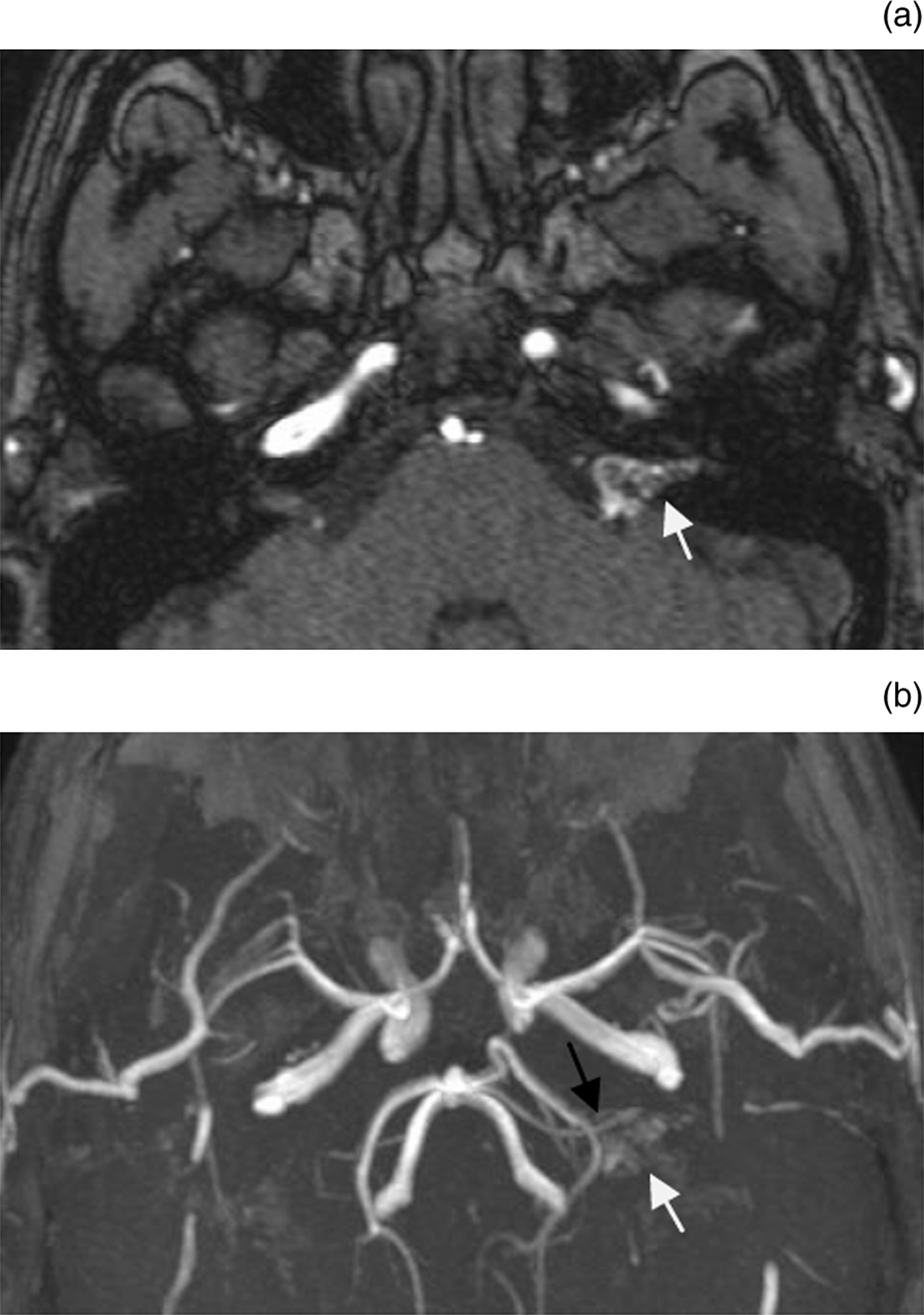 An Arteriovenous Malformation Within The Internal Acoustic Meatus And