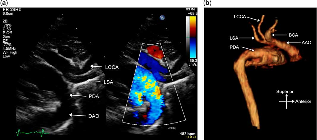 Echocardiography Of Coarctation Of The Aorta Aortic Arch Hypoplasia