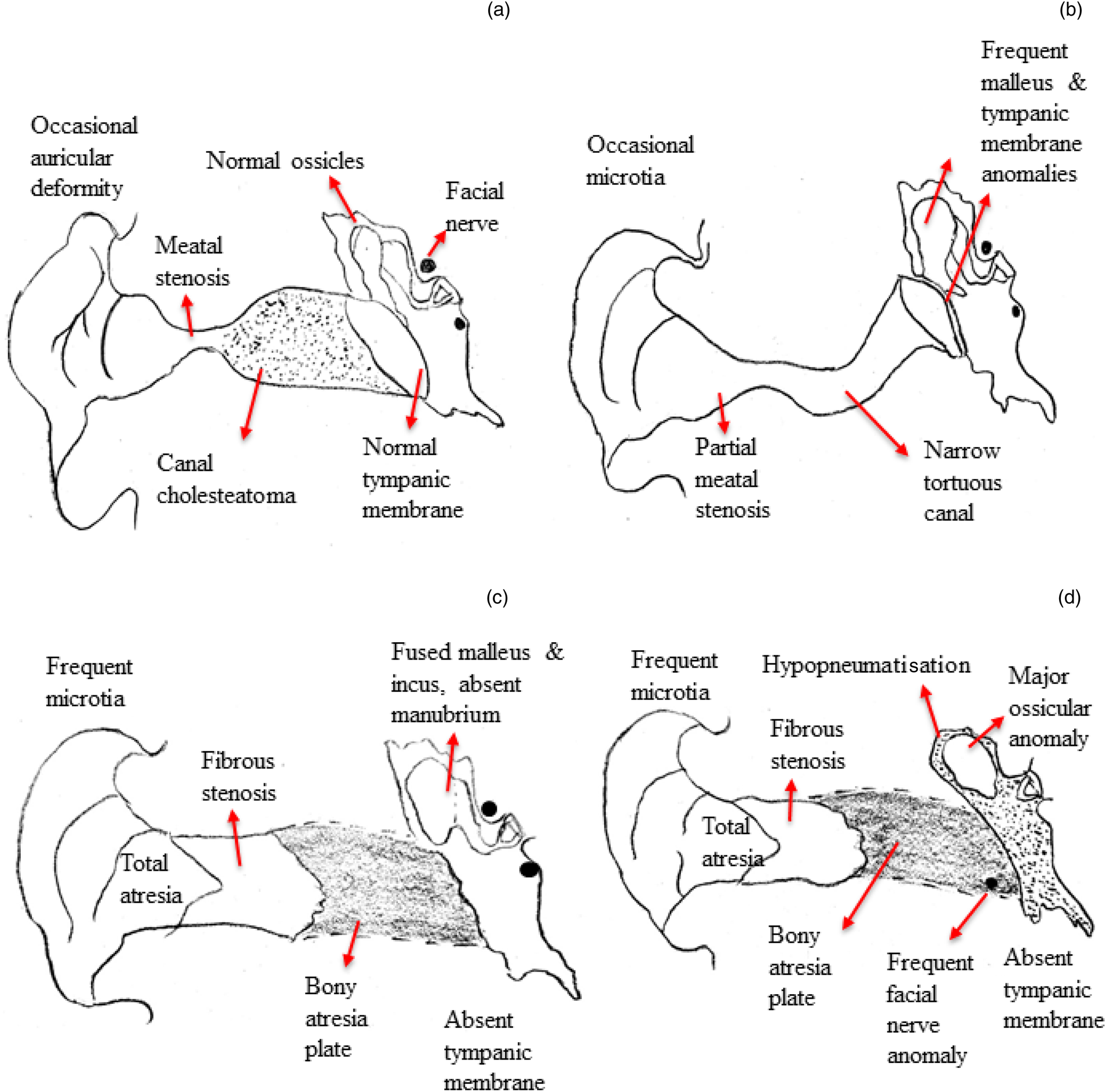 High Resolution Computed Tomography Evaluation Of Congenital Aural