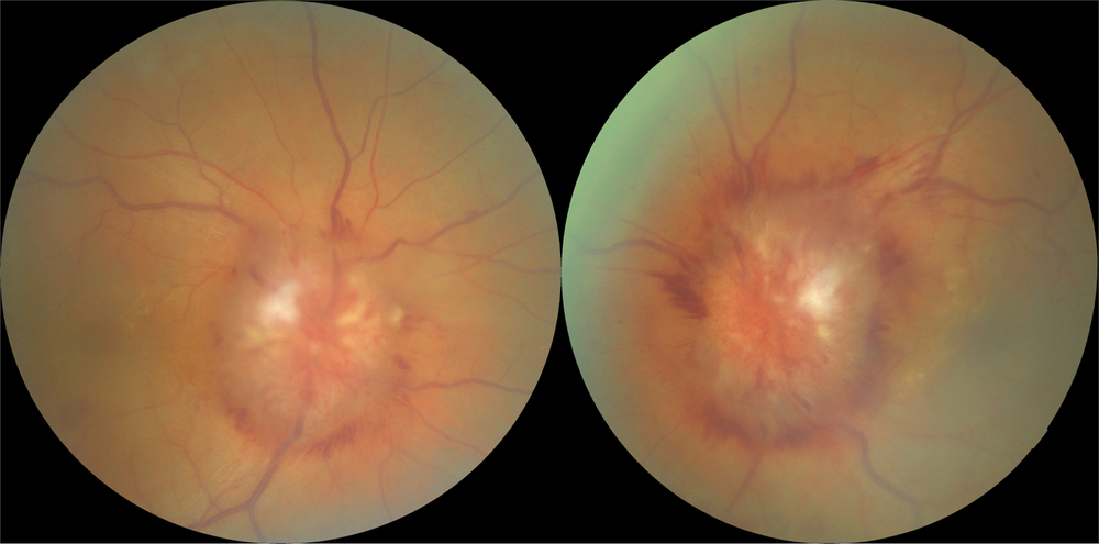 Papilledema And Bilateral Optic Neuropathy Dual Mechanism For Visual