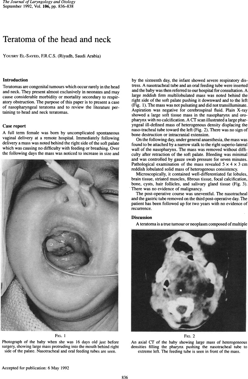 Teratoma Of The Head And Neck The Journal Of Laryngology Otology