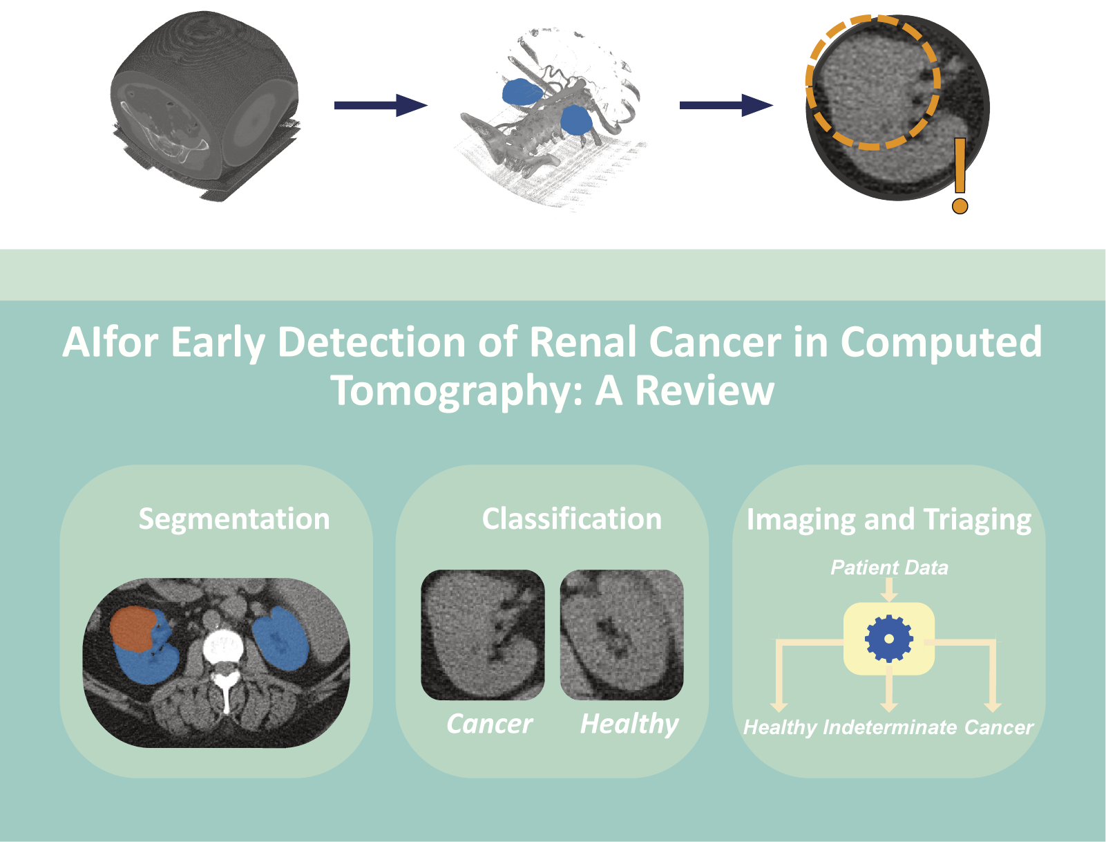 graphical abstract for Artificial intelligence for early detection of renal cancer in computed tomography: A review - open in full screen