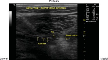 popliteal nerve block ultrasound