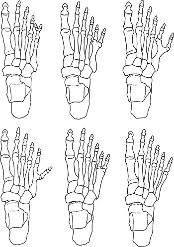 POLYDACTYLY AND THE MAYA: A REVIEW AND A CASE FROM THE SITE OF ...
