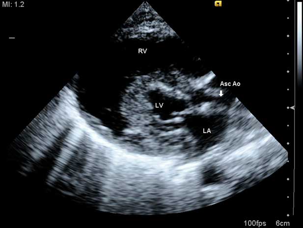 Echocardiography Of Hypoplastic Left Heart Syndrome Cardiology In The