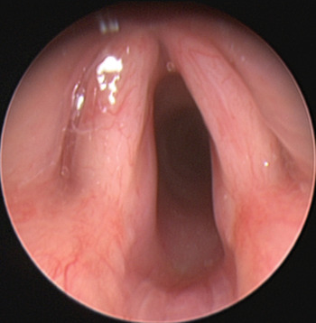 Confluent and reticulated papillomatosis medscape, Laryngeal papilloma medscape
