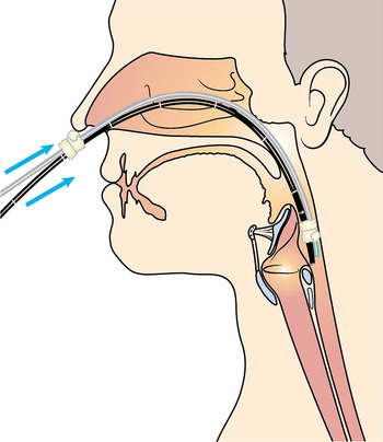 Nasogastric tube insertion in difficult cases with the aid of a ...