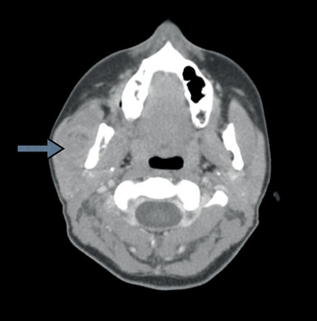 Ewing's sarcoma of the masseter muscle | The Journal of Laryngology ...