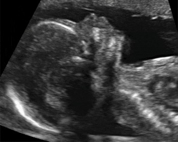 trisomy 21 ultrasound