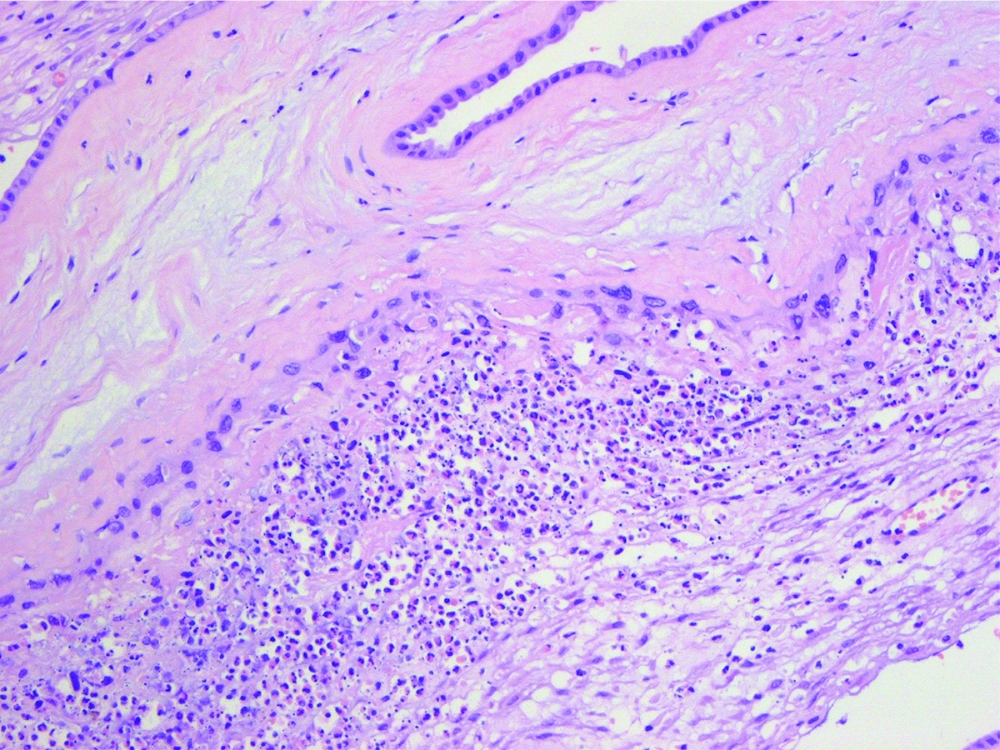 HISTOLOGICAL CHORIOAMNIONITIS: CURRENT CONCEPTS OF DIAGNOSIS ...