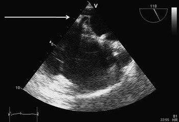 Successful transseptal puncture for radiofrequency ablation of left ...