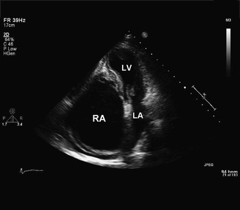 Ebstein’s malformation presenting with tricuspid stenosis: 1-year ...