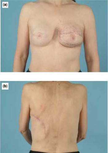 Bilateral breast reconstruction, Breast Cancer Online
