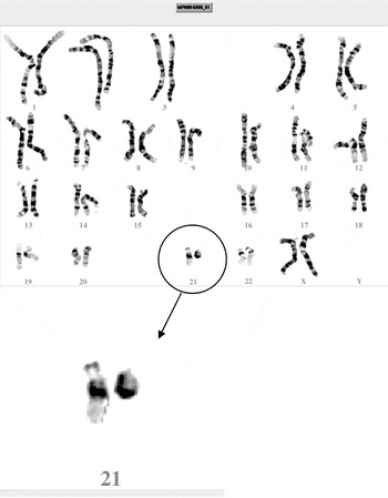Ring chromosome 20 syndrome: genetics and clinical characteristics