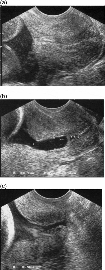 PREMATURE CERVICAL CHANGE AND THE USE OF CERVICAL CERCLAGE Fetal