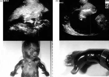 diastrophic dysplasia ultrasound