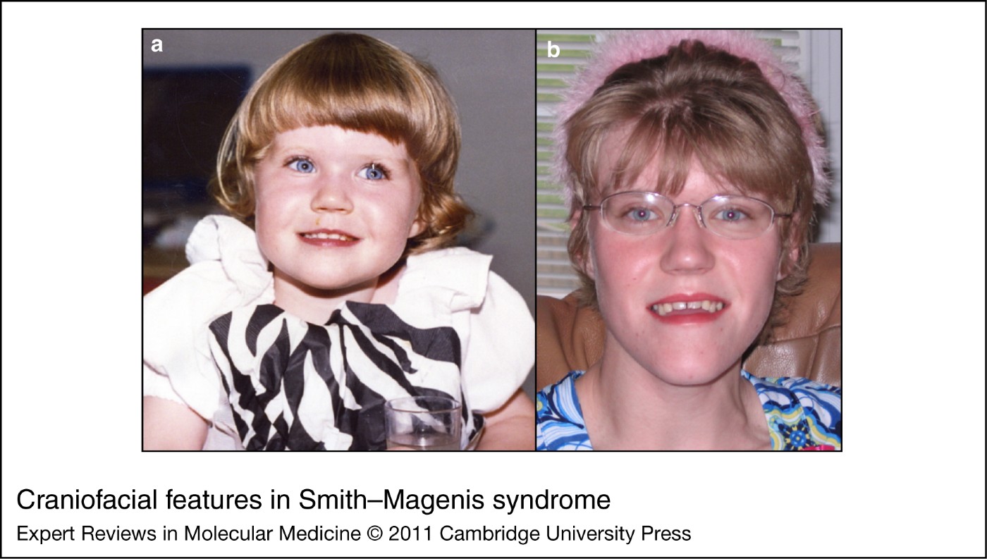 smith-magenis-syndrome-haploinsufficiency-of-rai1-results-in-altered