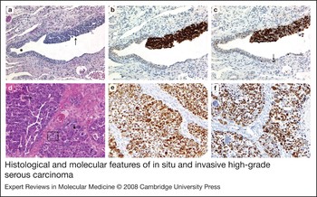 Critical molecular abnormalities in high-grade serous carcinoma of the