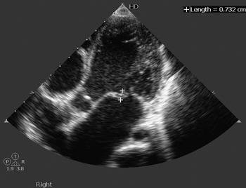 The efficacy of echocardiographic criterions for the diagnosis of ...