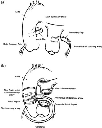 Towards an anatomically correct repair for anomalous left coronary ...