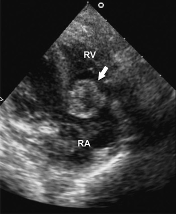 Excision of the tricuspid valve in a baby with Candida endocarditis ...