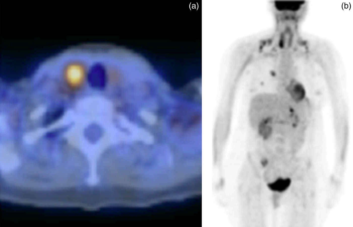 Incidental Head And Neck Findings On 18f Fluoro Deoxy Glucose Positron