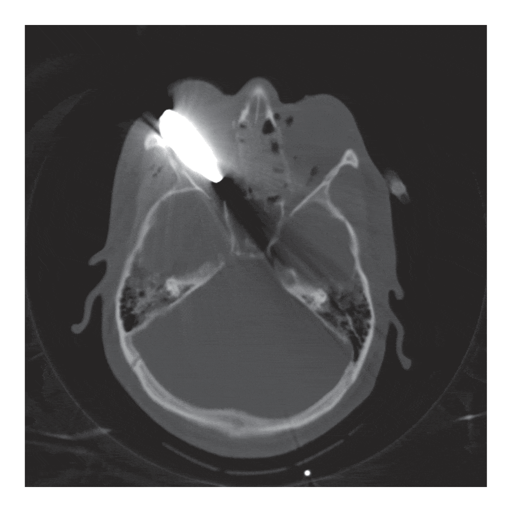 Blast Eye Injuries A Review for First Responders Disaster Medicine