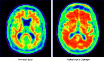 Alzheimer's disease drug development: translational neuroscience ...