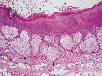 Lingual dermoid cyst with congenital discharging sinus: a rare entity ...