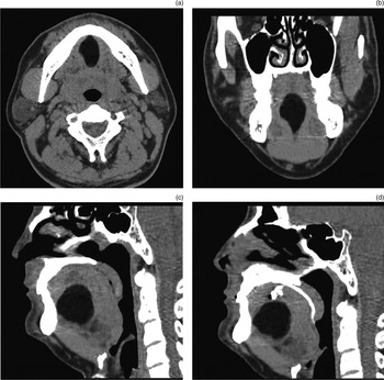 Lingual dermoid cyst with congenital discharging sinus: a rare entity ...