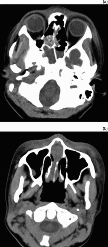 Nasal Septal Abscess And Facial Cellulitis Caused By Community Acquired Methicillin Resistant