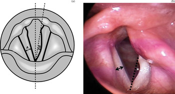 Posterior glottic gap and age as factors predicting voice outcome of ...