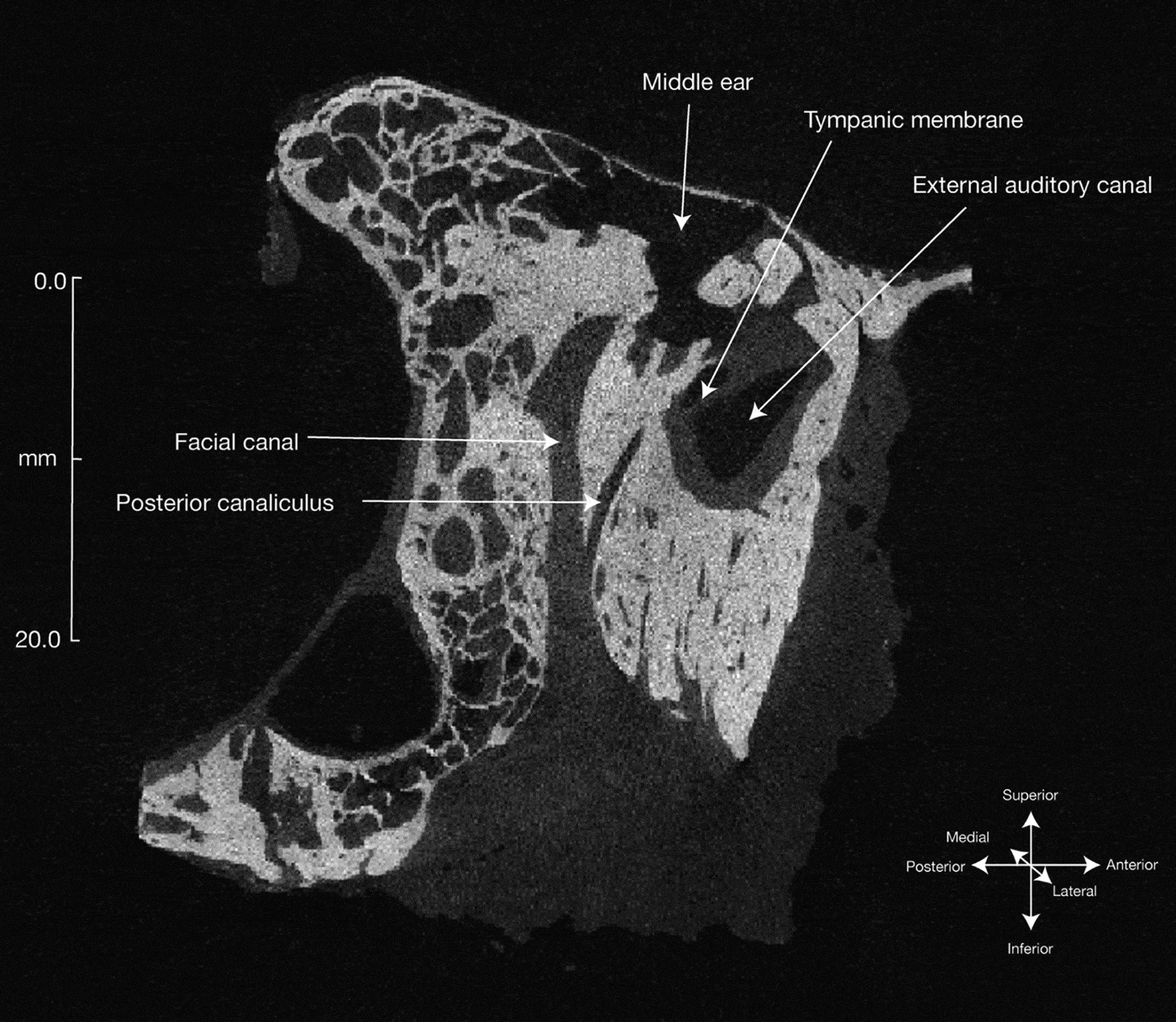 Clinical Anatomy Of The Chorda Tympani A Systematic Review The