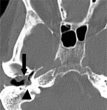 Spectrum of radiological appearances of necrotising external otitis: a