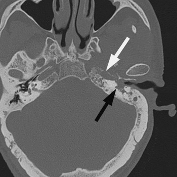 Primary temporal inverted papilloma with premalignant change | The ...