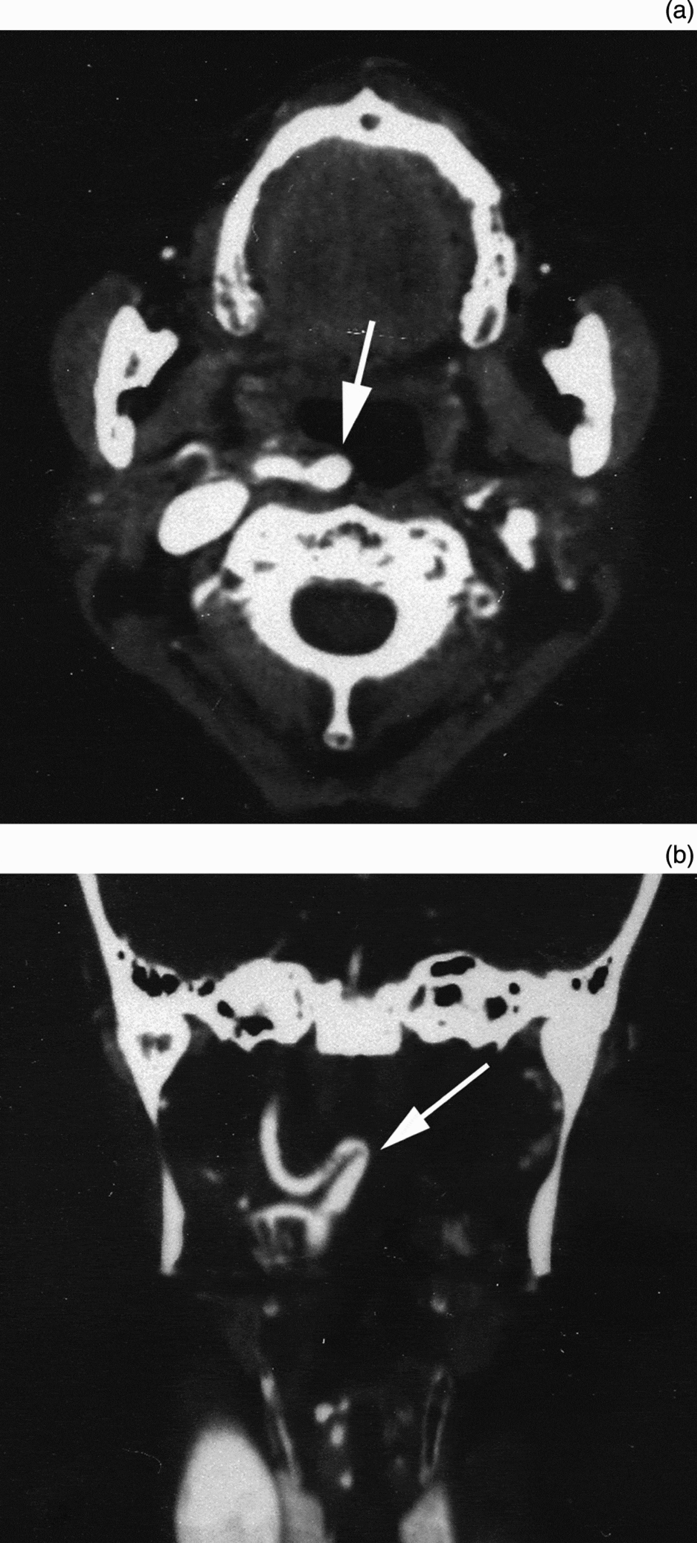 Tortuous internal carotid artery presenting as a pharyngeal mass | The