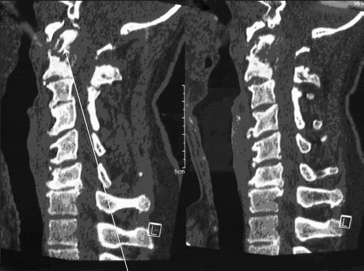 Endoscopic Endonasal Decompression Of Spinal Stenosis With Myelopathy Secondary To Cranio 