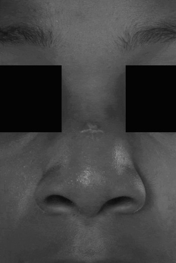 dermoid cyst bridge of nose