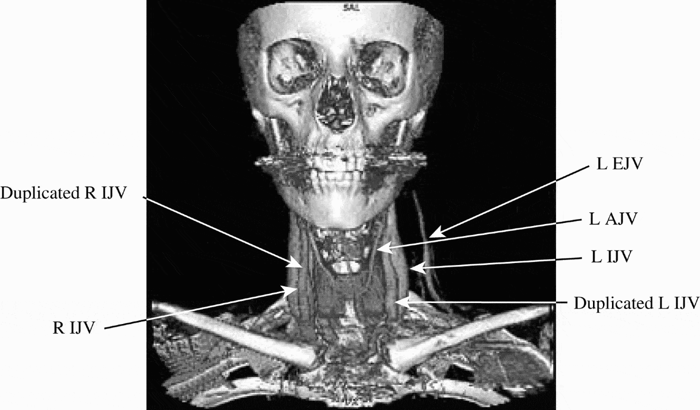 Duplication Of Internal Jugular Veins Case Report The Journal Of Laryngology And Otology