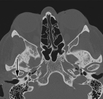 Gustatory Otorrhoea: A Rare Case Of Congenital External Ear Salivary 