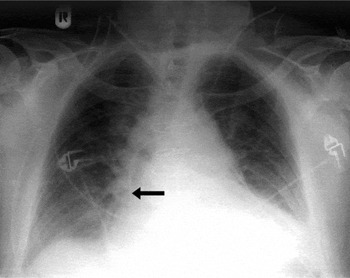 Interventional Radiology Procedures: Chest Port Placement - Stepwards