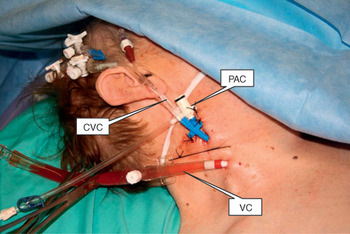 Minimally invasive cardiac surgery (Chapter 34) - Core Topics in