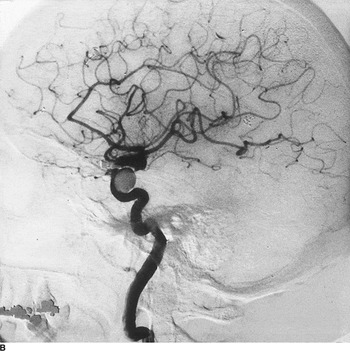 Internal elastic lamina is disorganized in brain and extra-cranial