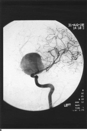 Subarachnoid Hemorrhage and Aneurysms (Chapter 17) - Toole's 