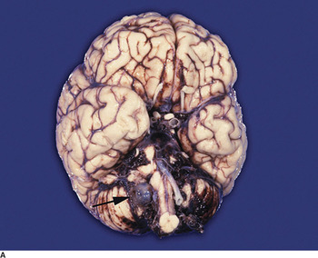 Subarachnoid Hemorrhage and Aneurysms (Chapter 17) - Toole's 