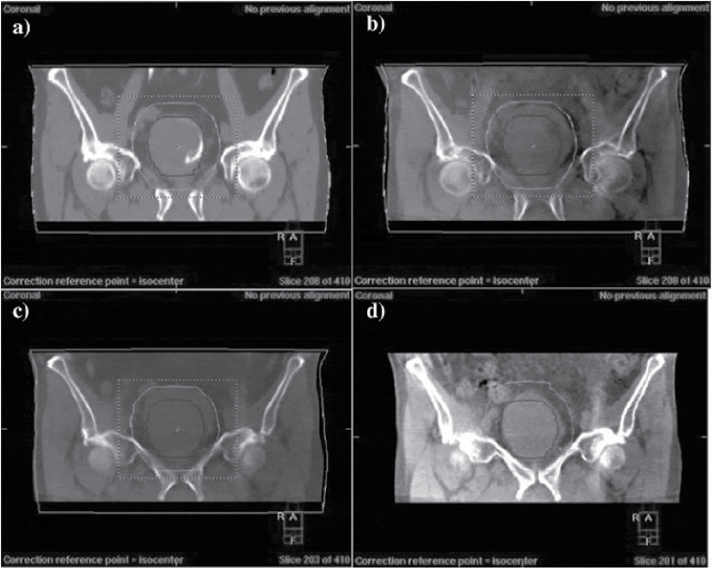 Delivering adaptive radiotherapy to the bladder during radical treatment Journal of