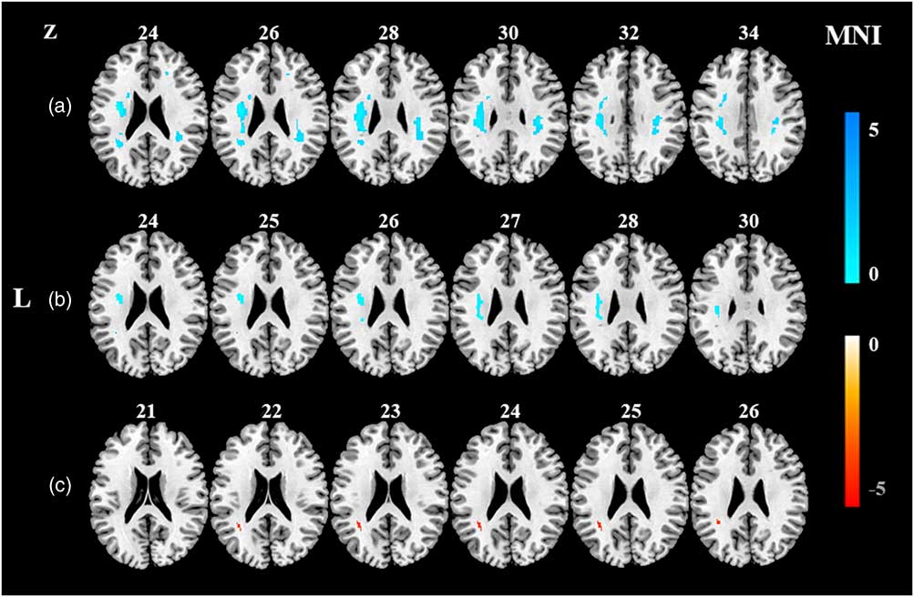 Greater Loss of White Matter Integrity in Postural Instability and Gait ...