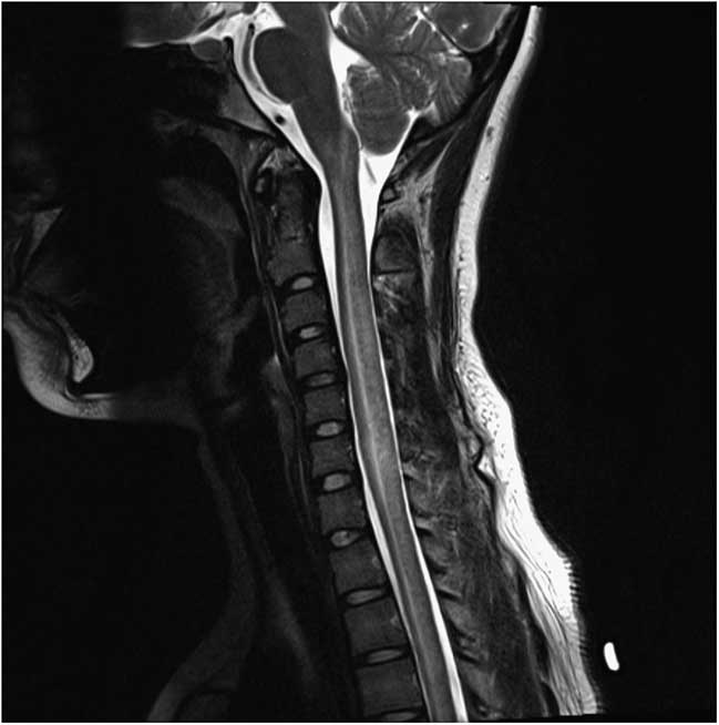 Diffuse Bacterial Meningitis and Myelitis Secondary to a Diplococcus ...